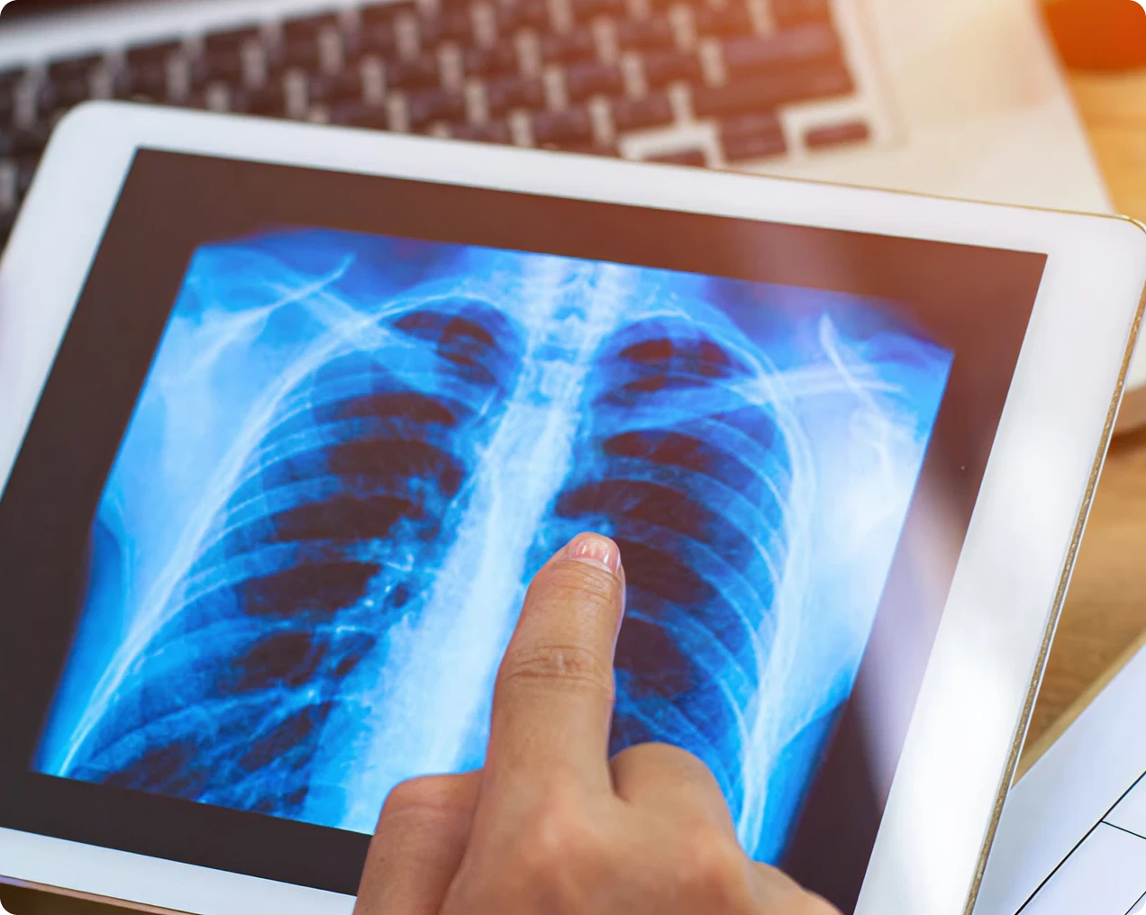 Finger pointing at chest X-ray